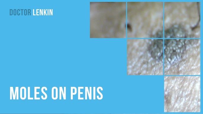 Mole on the Penis According to Traditional Beliefs

Samudrik