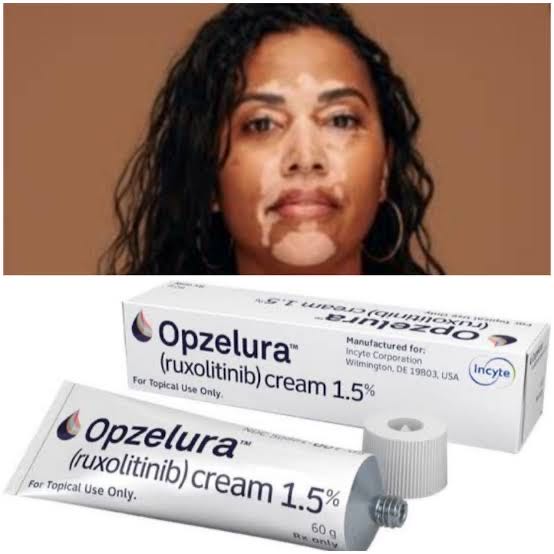 Vitiligo: Causes, Treatment, and Is There a Permanent Cure?
